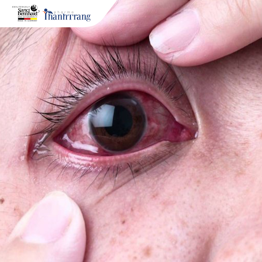 Đau mắt đỏ là tình trạng mắt bị nhiễm trùng do loại vi khuẩn có tên là Staphylococcus gây ra