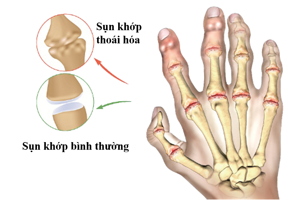 ẢNh: Sụn khớp thoái hóa