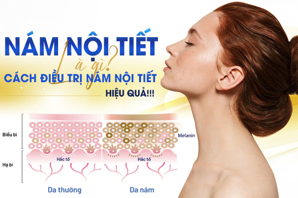 Nám nội tiết là gì?