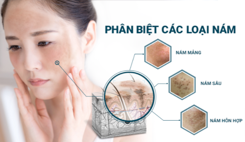 Việc nhận biết loại nám giúp bạn lựa chọn đúng phương pháp điều trị. Theo cấu trúc và độ sâu của sắc tố, nám da được chia thành 3 dạng chính:
