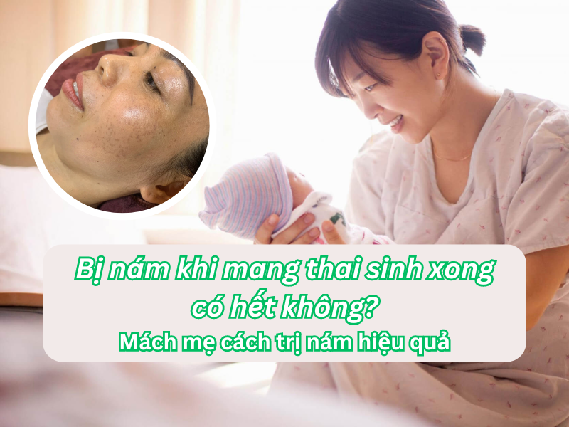 Bị nám khi mang thai sinh xong có hết không? - Mách mẹ cách trị nám hiệu quả