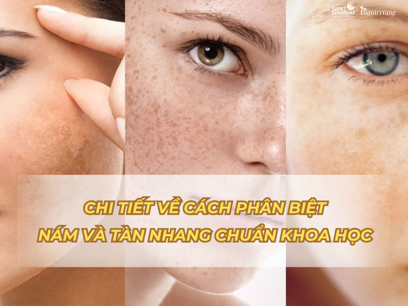 Chi tiết về cách phân biệt nám và tàn nhang chuẩn khoa học