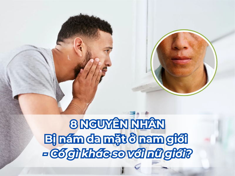 8 Nguyên nhân bị nám da mặt ở nam giới - có gì khác so với nữ giới?