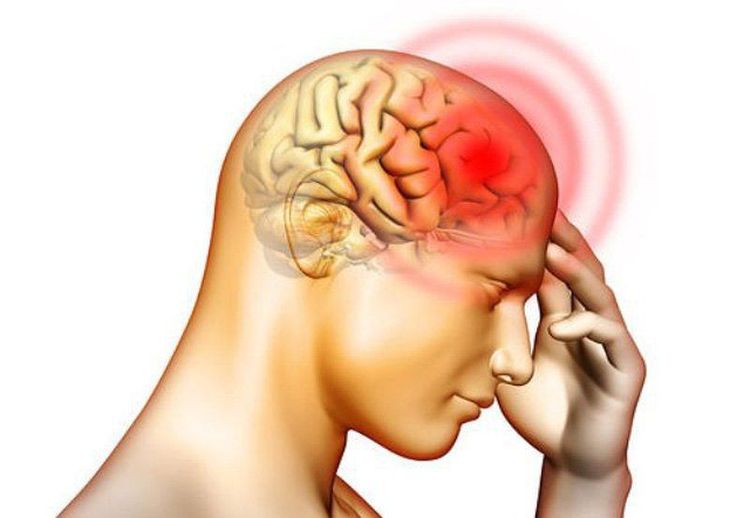 Đau nửa đầu bên phải: Nguyên nhân và cách khắc phục an toàn
