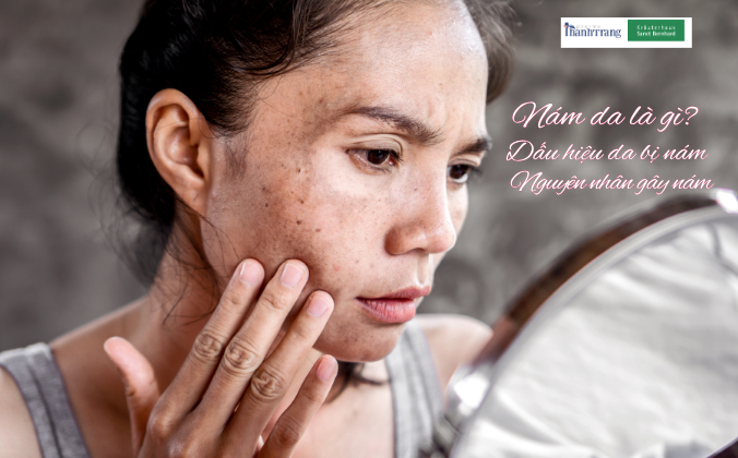 Nguyên nhân nám da, tăng sắc tố da, melanin, tế bào hắc tố.